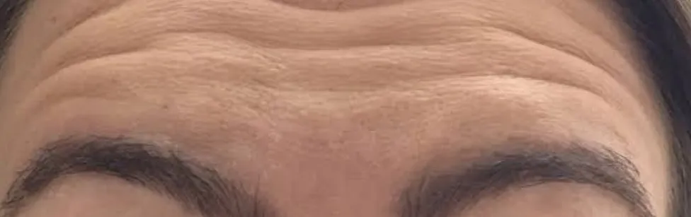 Testa antes do botox, com linhas de expressão marcadas